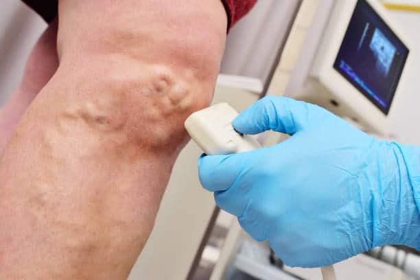 Vein Disease Diagnosis in Munster, IN