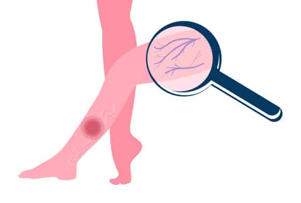 Varicose Vein Treatment in Munster, IN