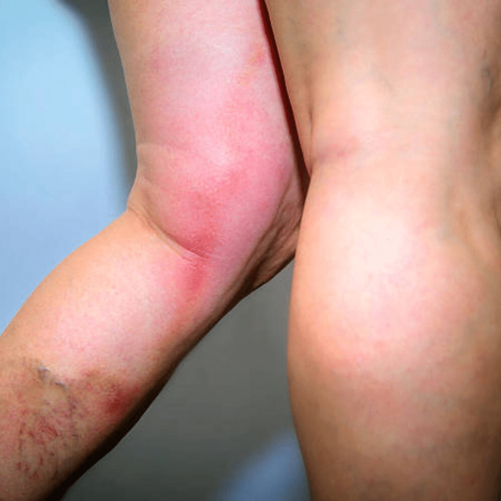 Thrombophlebitis Treatment in Munster, IN