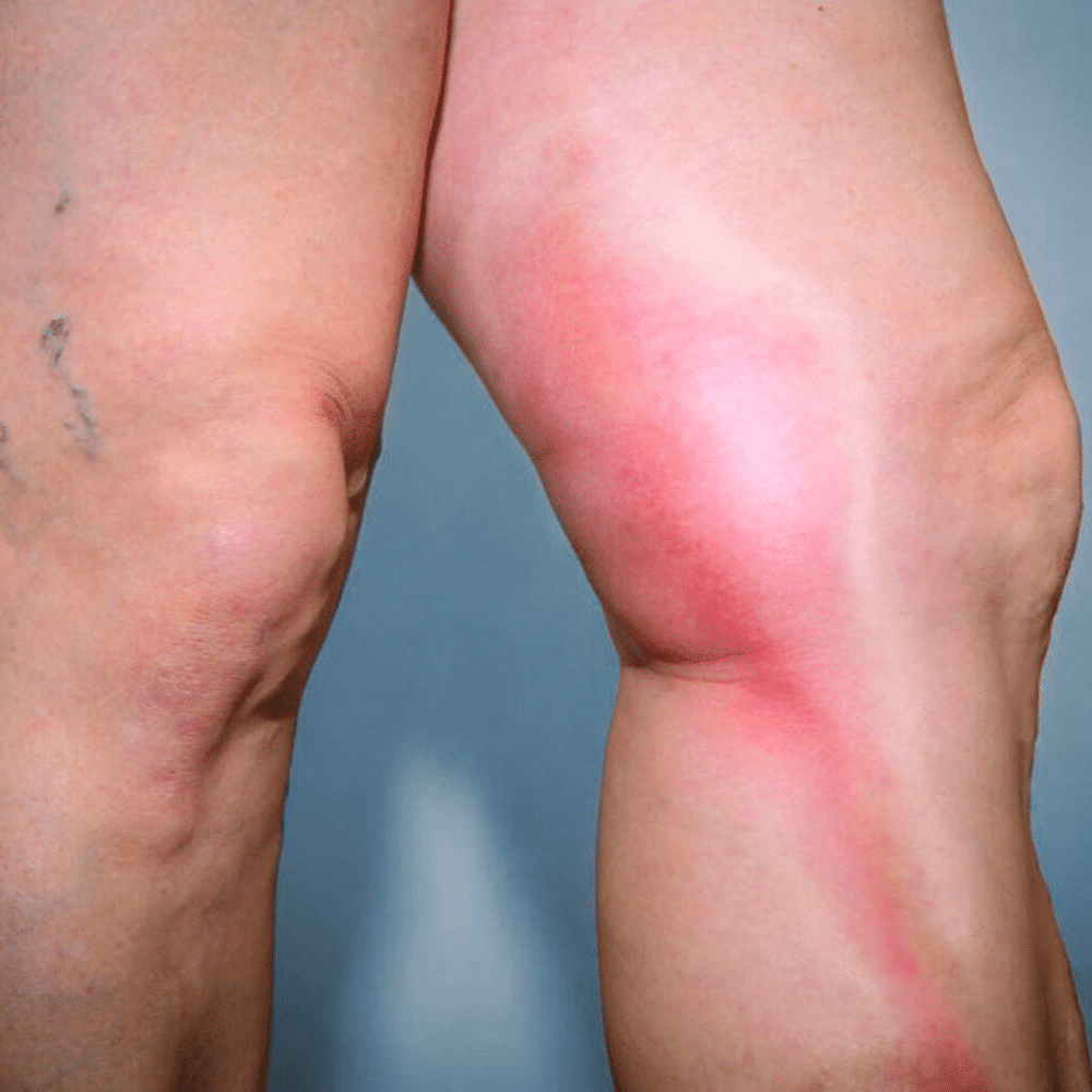Thrombophlebitis Treatment in Munster, IN