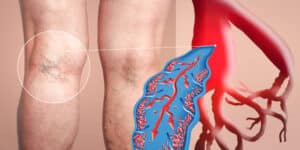 Chronic Venous Insufficiency (CVI) Treatment in Munster, IN