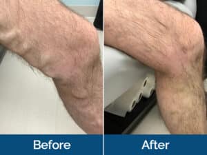 Vein Treatment Before & After