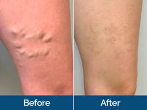 Vein Treatment Before & After