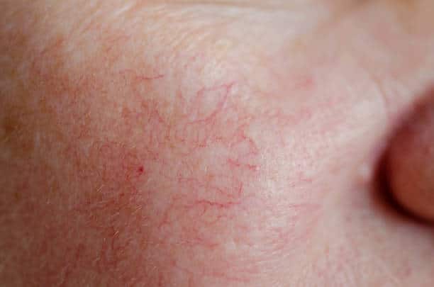 Spider Vein Treatment in Munster, IN